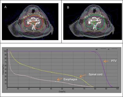 Comparison of Ray Tracing and Monte Carlo Calculation Algorithms for Spine Lesions Treated With CyberKnife